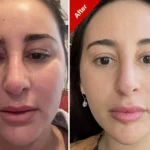 Navigating the Dangers: Familiar Facet Results of Ozempic