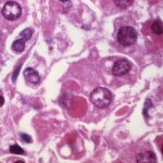 US exit from the World Health Organization marks a new era in global health policy – here’s what the US, and world, will lose