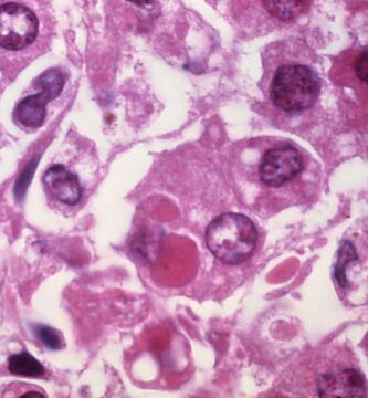 US exit from the World Health Organization marks a new era in global health policy – here’s what the US, and world, will lose