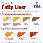 Breaking Down the Top Contributors to Fatty Liver Disease