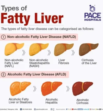 Breaking Down the Top Contributors to Fatty Liver Disease